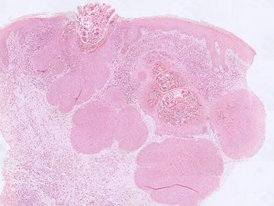 Histologie molluscum contagiosum