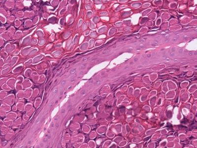 Histologie molluscum contagiosum