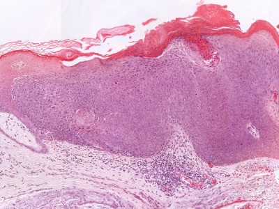 Histologie morbus Bowen