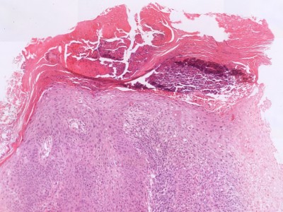 Histologie morbus Bowen