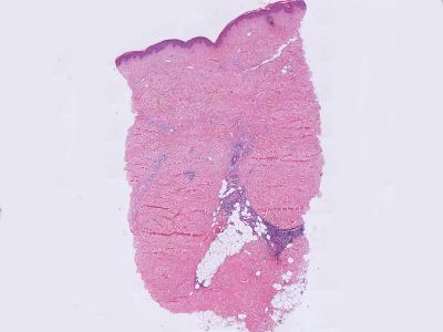 Histologie sclerodermie / morfea