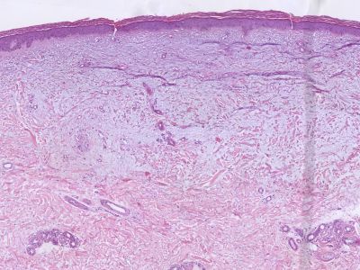 Histologie mucinosis