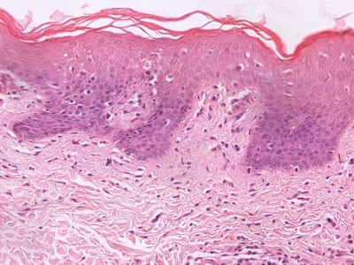 Histologie mycosis fungoides