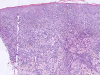 Histologie mycosis fungoides