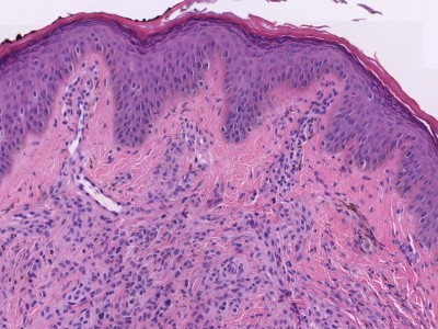 Histologie dermale naevus naevocellularis