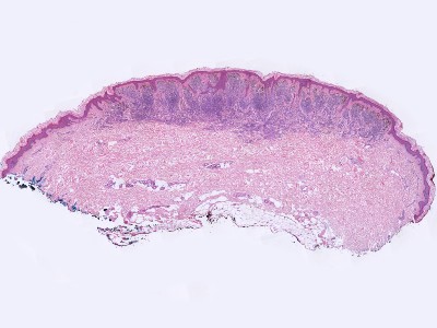 Histologie dermale naevus naevocellularis