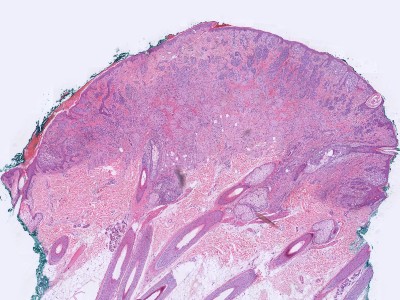Histologie dermale naevus naevocellularis