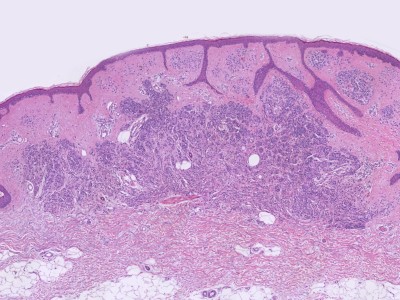 Histologie dermale naevus naevocellularis