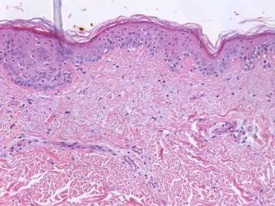 Histologie dysplastische naevus