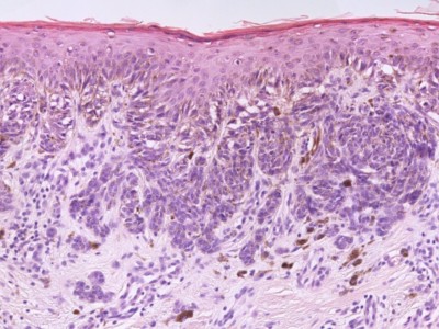 Histologie dysplastische naevus