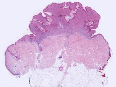 Histologie naevus naevocellularis papillomatosus