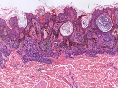 Histologie naevus naevocellularis papillomatosus