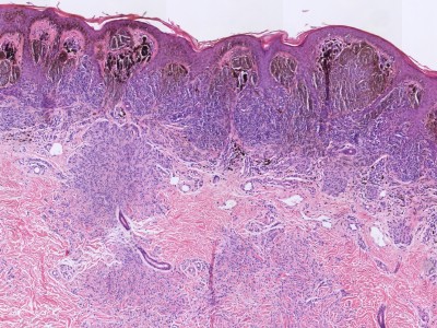 Histologie compound naevus