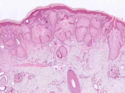Histologie naevus sebaceus