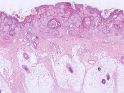 Histologie naevus sebaceus