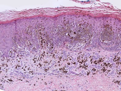Histologie naevus van Reed