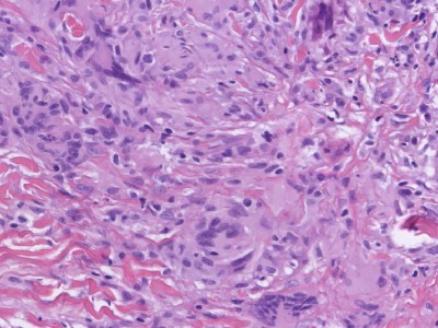 Histologie necrobiosis lipoidica