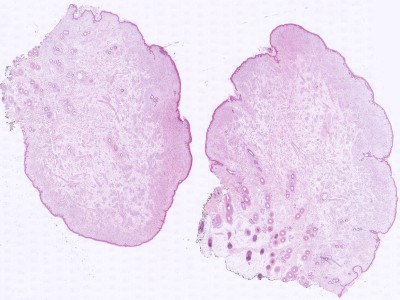 Histologie neurofibroom