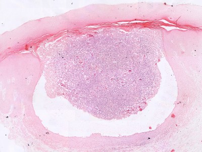 Histologie neurinoom