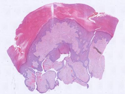 Histologie onychomatricoma