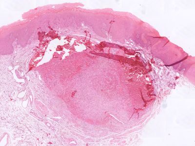 Histologie papillary endothelial hyperplasia