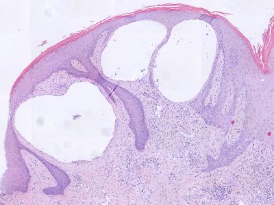 Histologie papillomatosis bij lymfoedeem