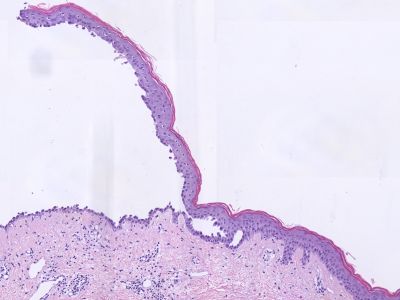 Histologie pemphigus vulgaris