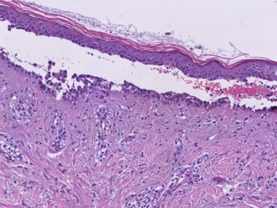 Histologie pemphigus vulgaris