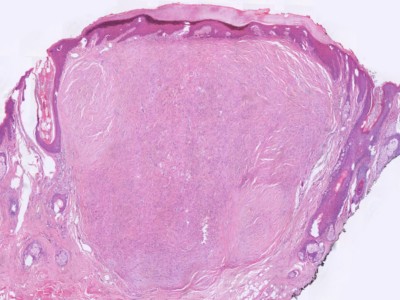 Histologie perineurioma