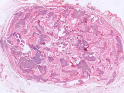 Histologie pilomatrixoma