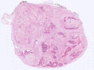 Histologie pilomatrixoma