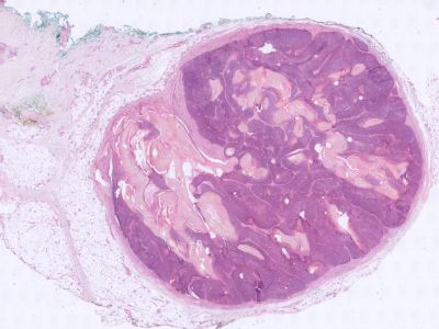 Histologie pilomatrixoma