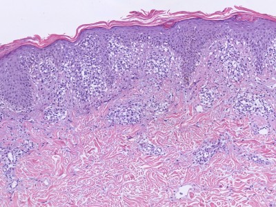 Histologie pityriasis rosea