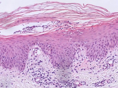 Histologie pityriasis rosea