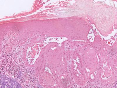 Histologie plaveiselcelcarcinoom