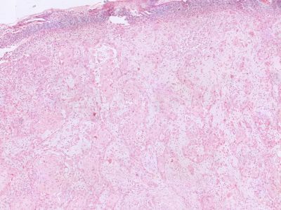 Histologie plaveiselcelcarcinoom