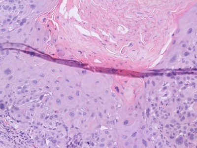 Histologie plaveiselcelcarcinoom