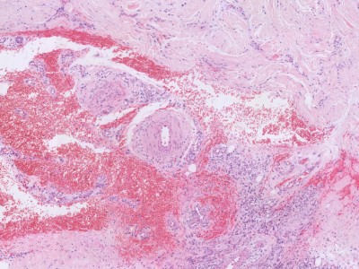 Histologie polyarteritis nodosa