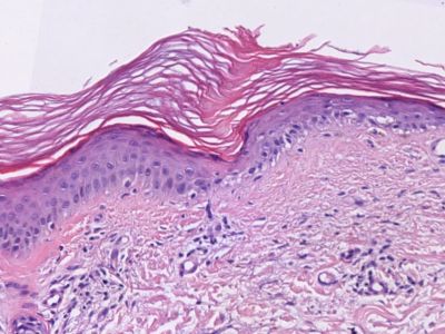 Histologie porokeratosis actinica