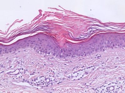 Histologie porokeratosis