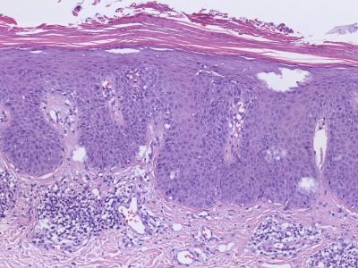 Histologie psoriasis