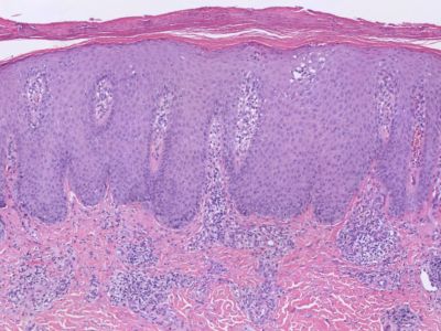 Histologie psoriasis