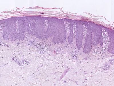 Histologie psoriasis