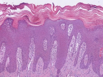 Histologie psoriasis