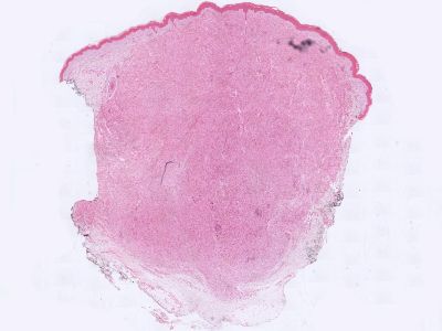 Histologie reticulohistiocytoma