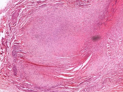 Histologie reuma nodulus