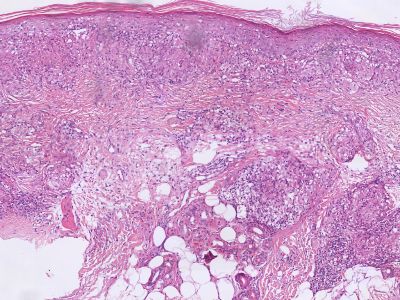 Histologie sarcoidose