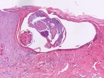Histologie scabies