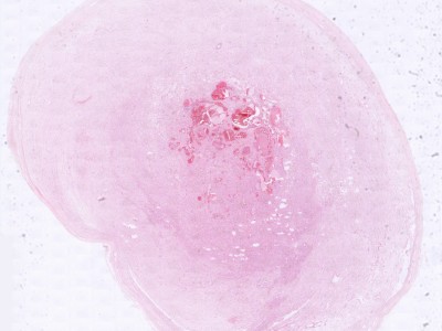 Histologie Schwannoma