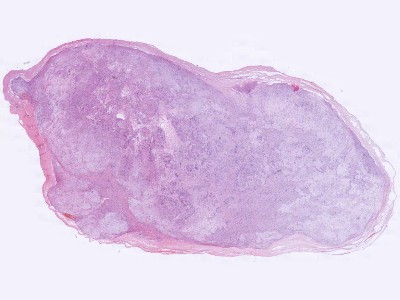 Histologie Schwannoma
